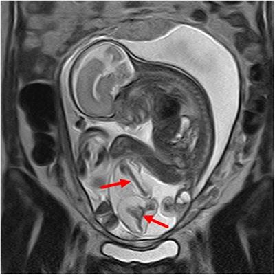 Prenatal MRI diagnosis and outcomes of abdominal or sacrococcygeal teratomas and parasitic fetuses